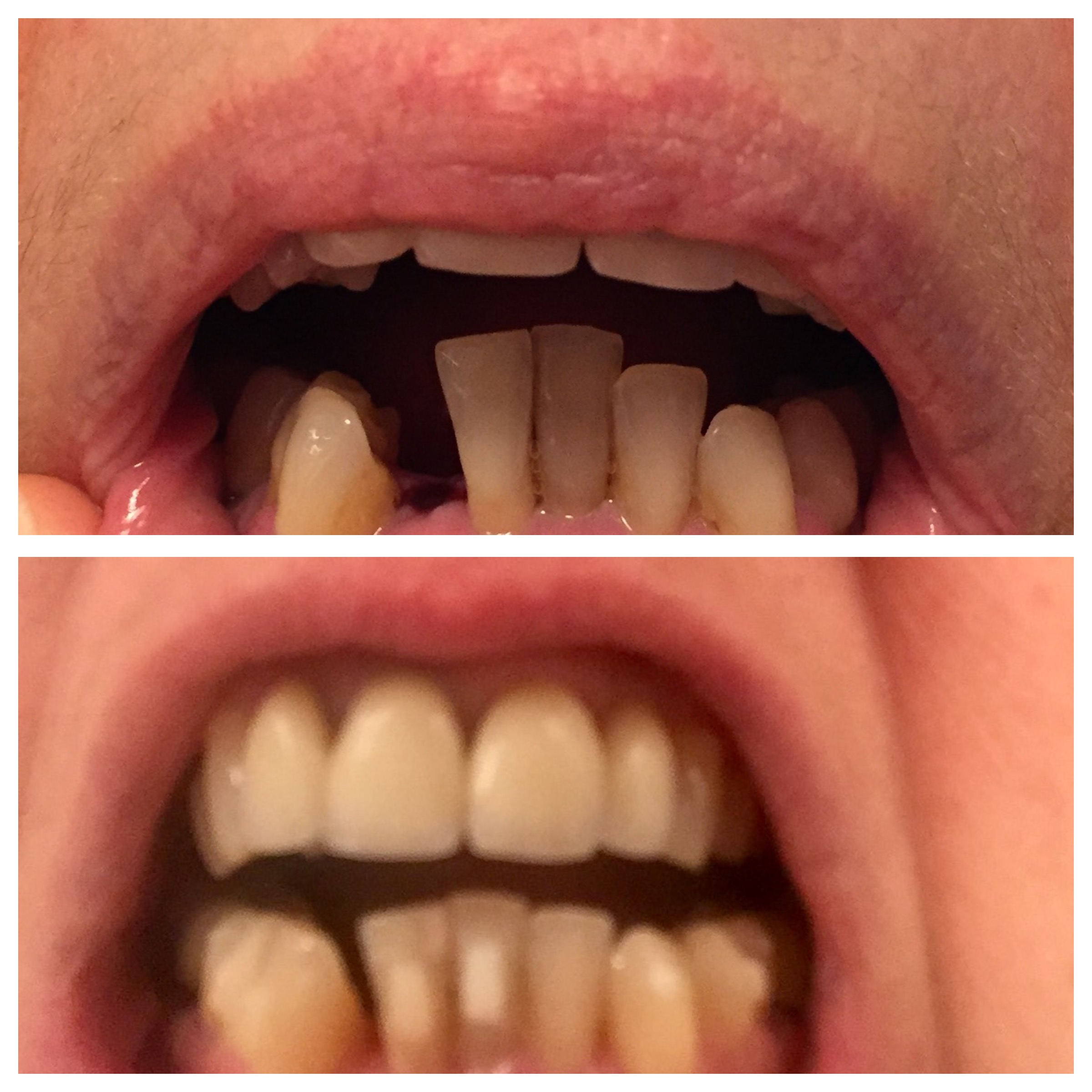 Se Faire Limer Les Dents Prix Tout Faire