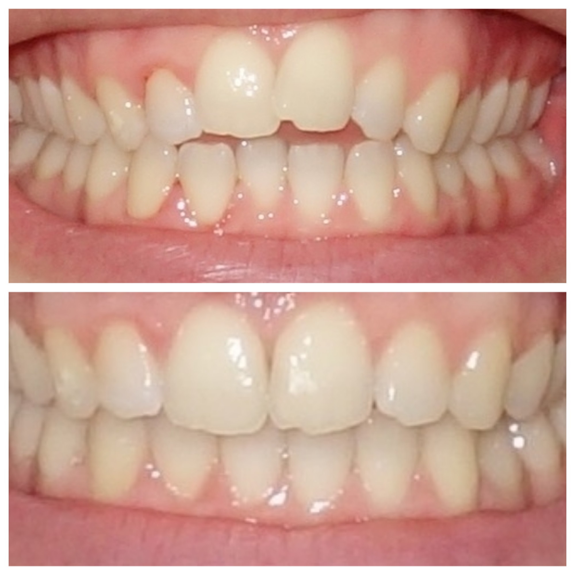 Se Faire Limer Les Dents Prix Tout Faire
