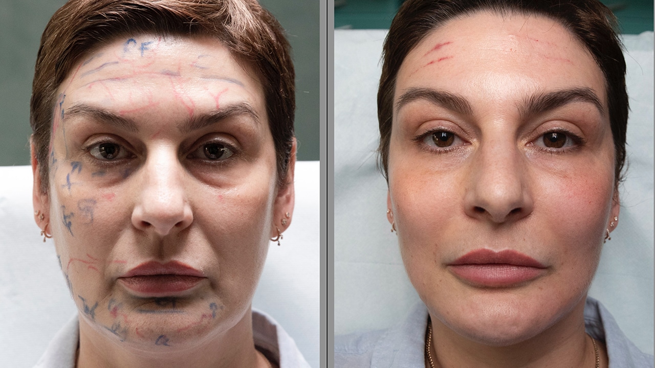Mes dernières injections Full face à l’acide hyaluronique Mon blog de filleMon blog de fille