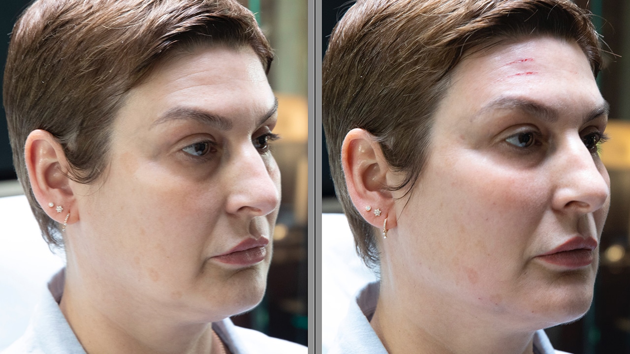 Mes dernières injections Full face à l’acide hyaluronique Mon blog de fille Mes dernières injections Full face à l’acide hyaluronique Mon blog de fille